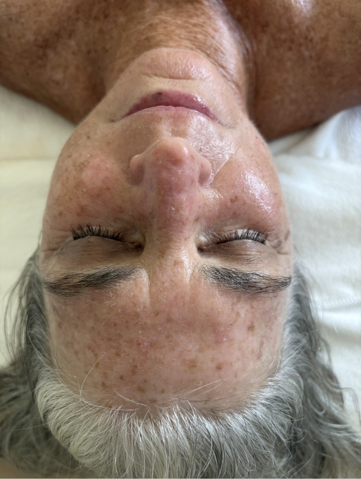 After skin treatment