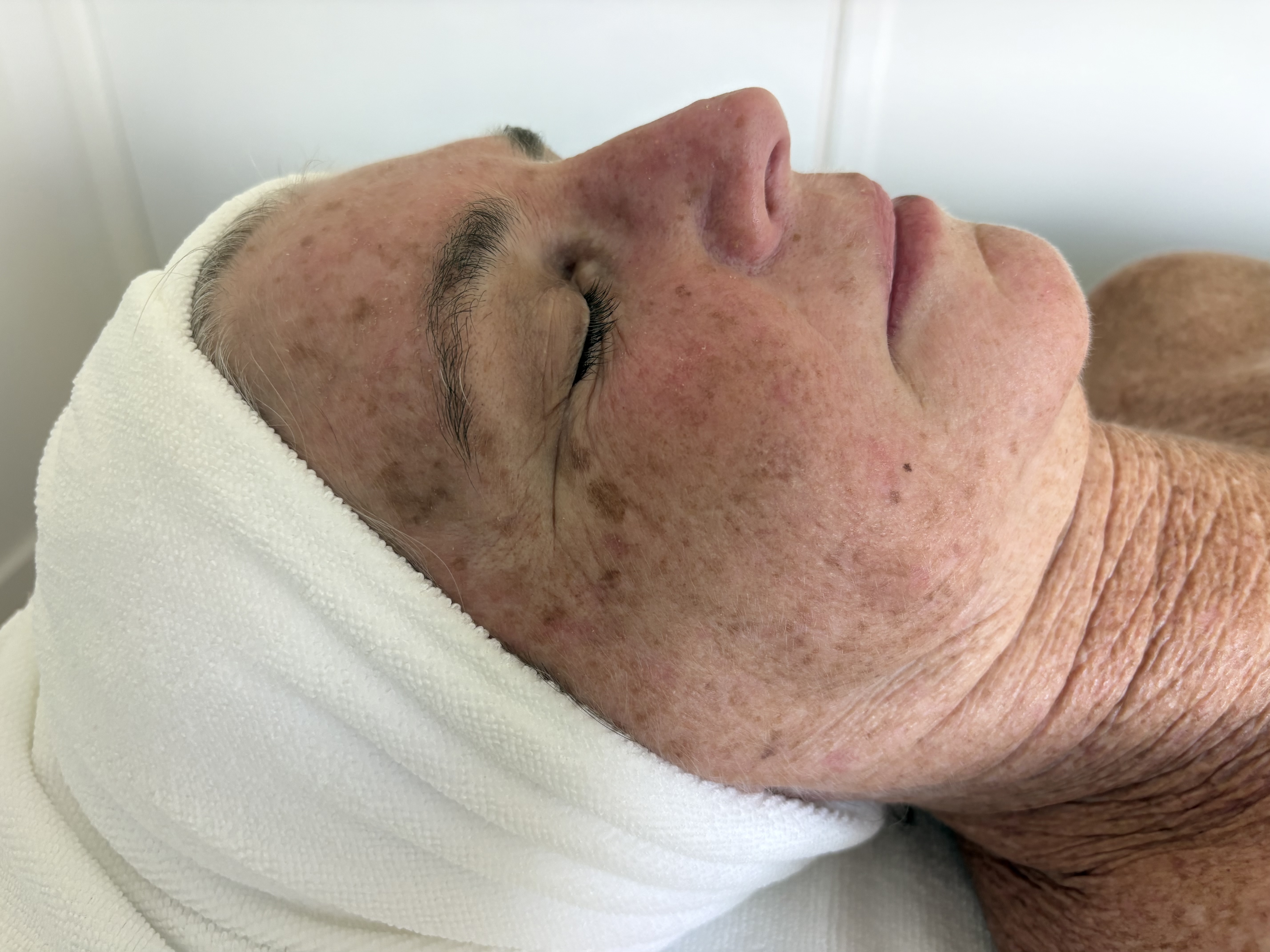 Before facial treatment