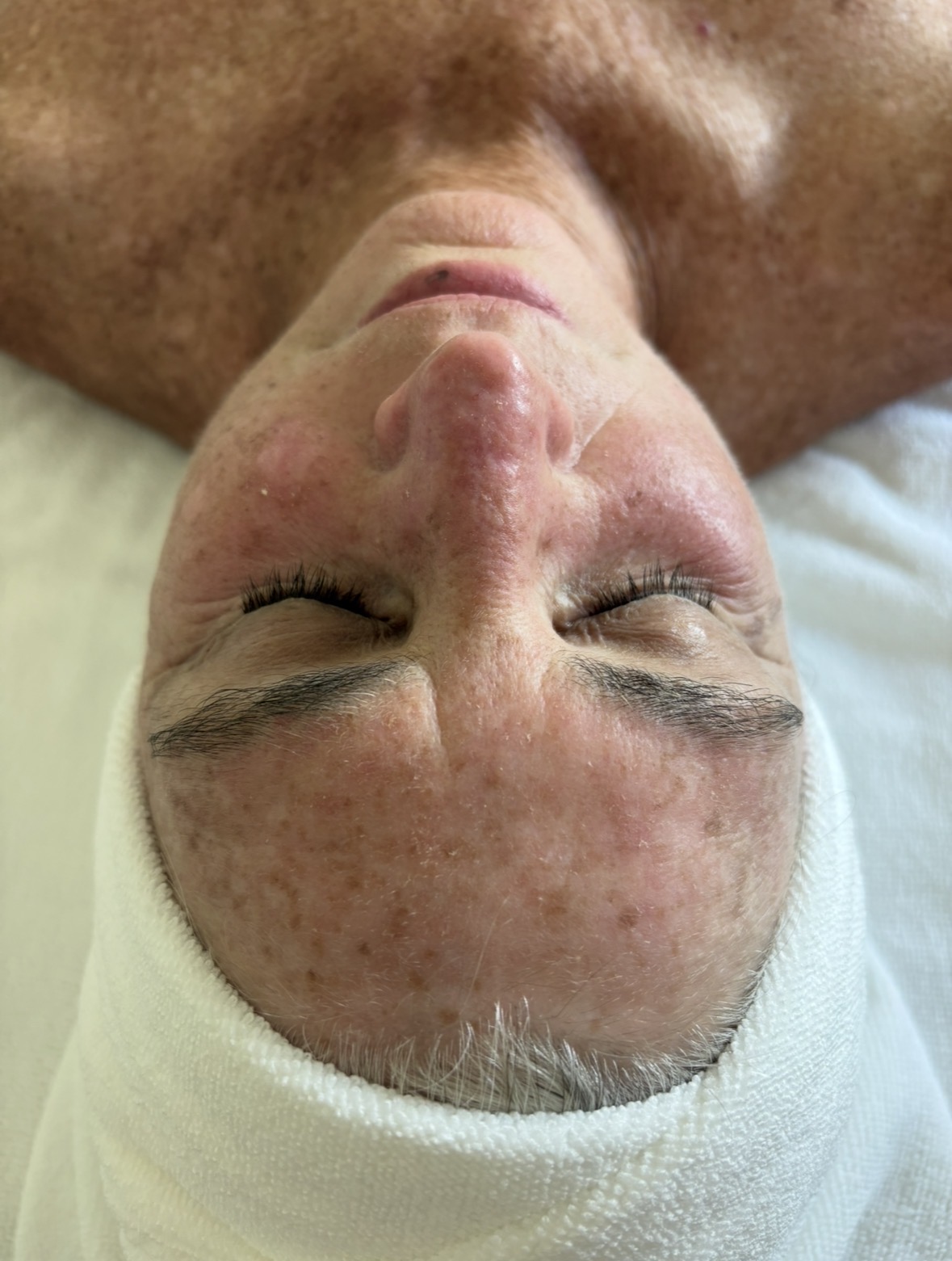 Before skin treatment
